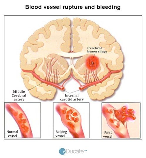 Image showing blood vessel rupture and bleeding